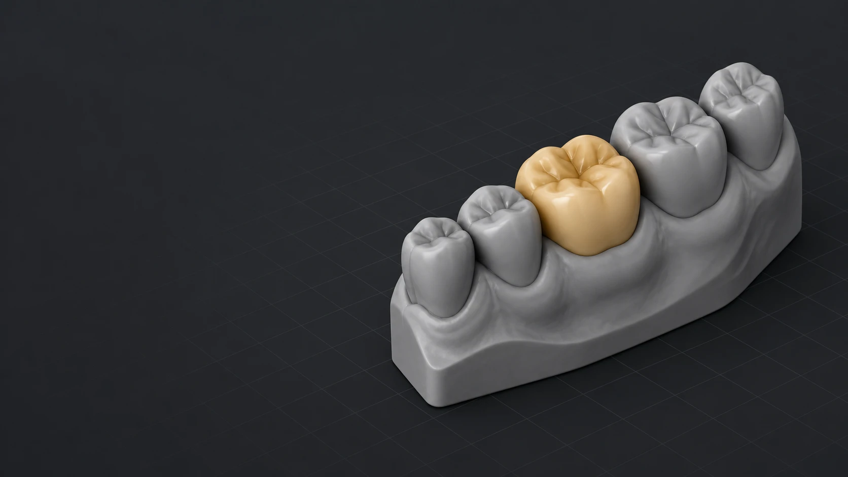 Modelo digital de una corona dental